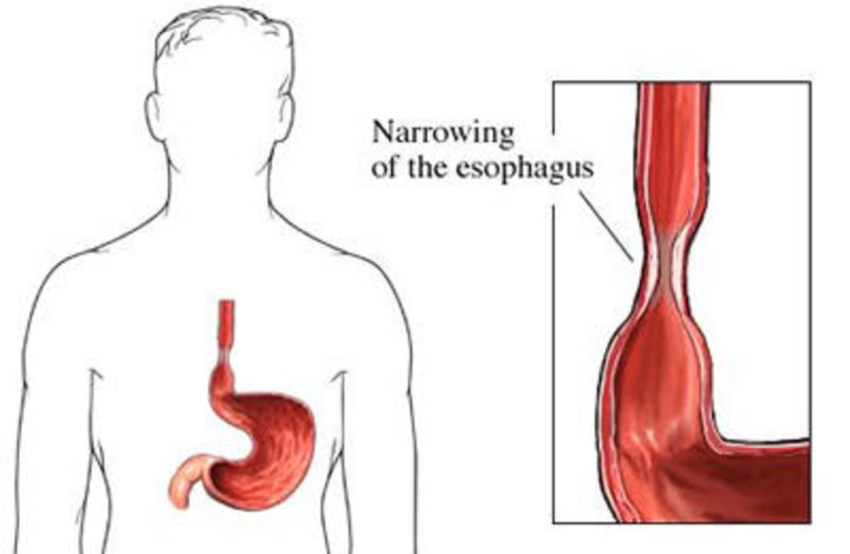 Dysphagia After A Neurological Episode