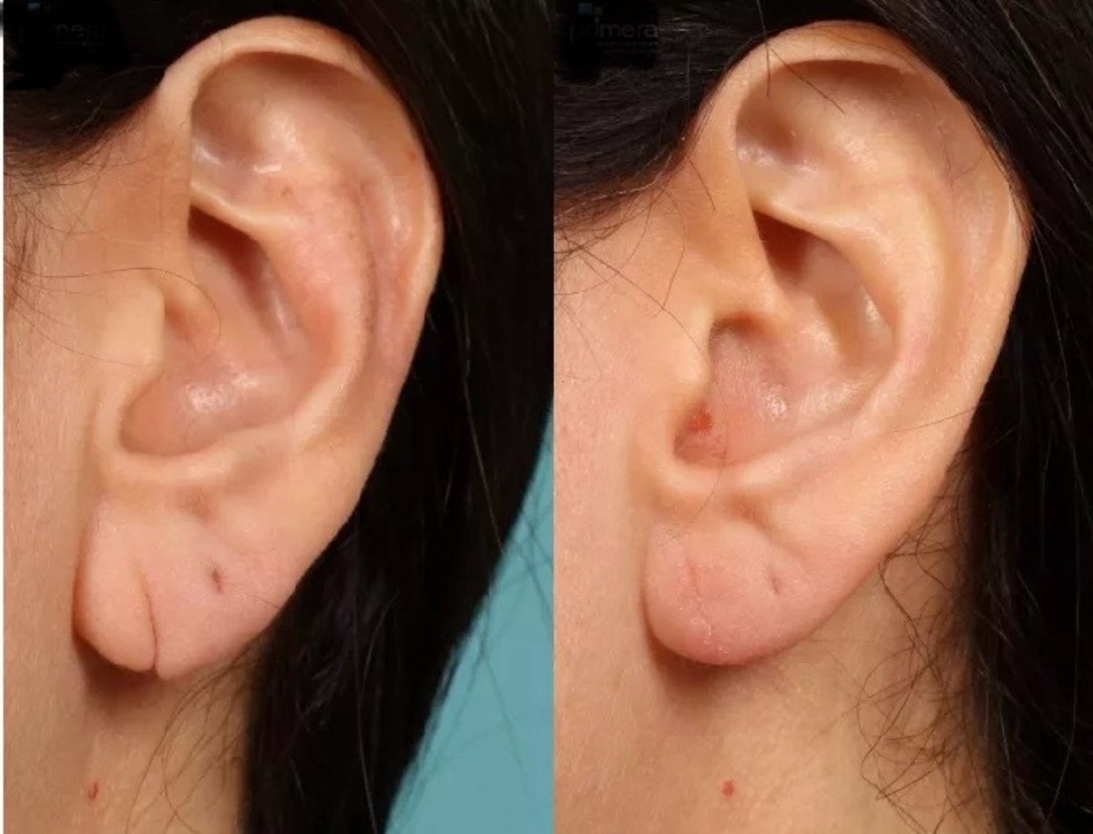 Why Ear injuries Tend to Heal well