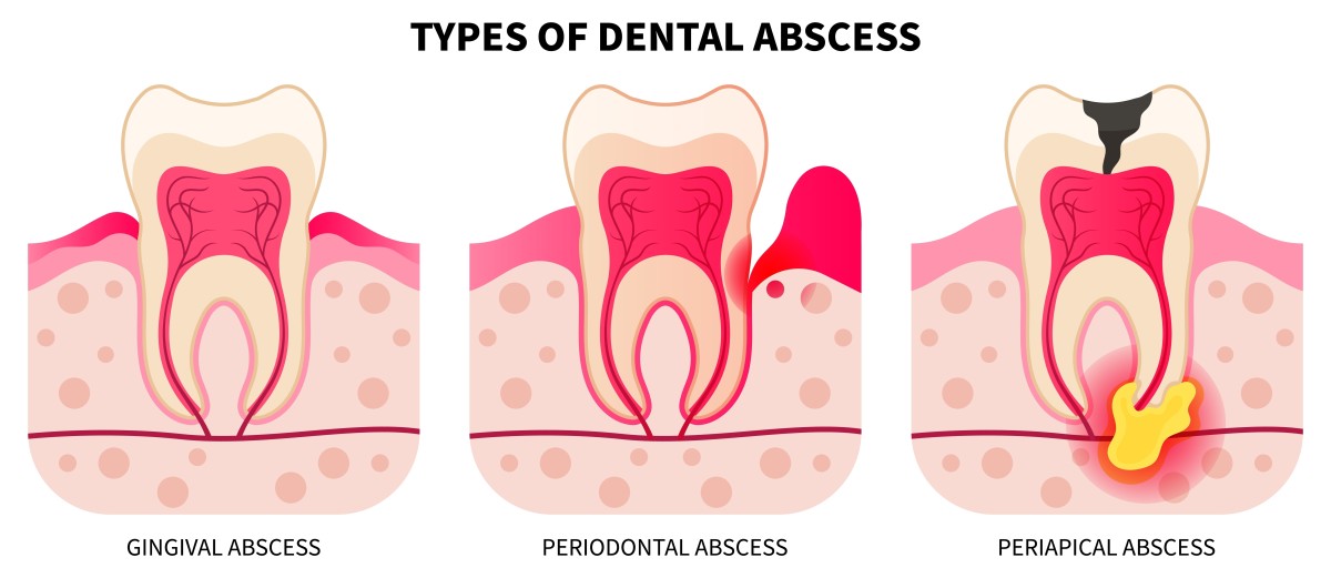 What Is a Tooth Abscess? Symptoms, Causes, and Treatment